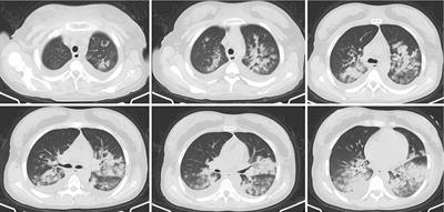 Rare case of pulmonary fat embolism and acute respiratory distress syndrome after liposuction and fat grafting: a case report